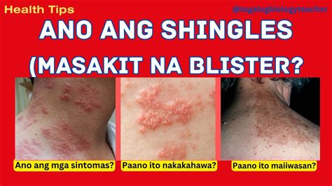 shingles meaning in tagalog.